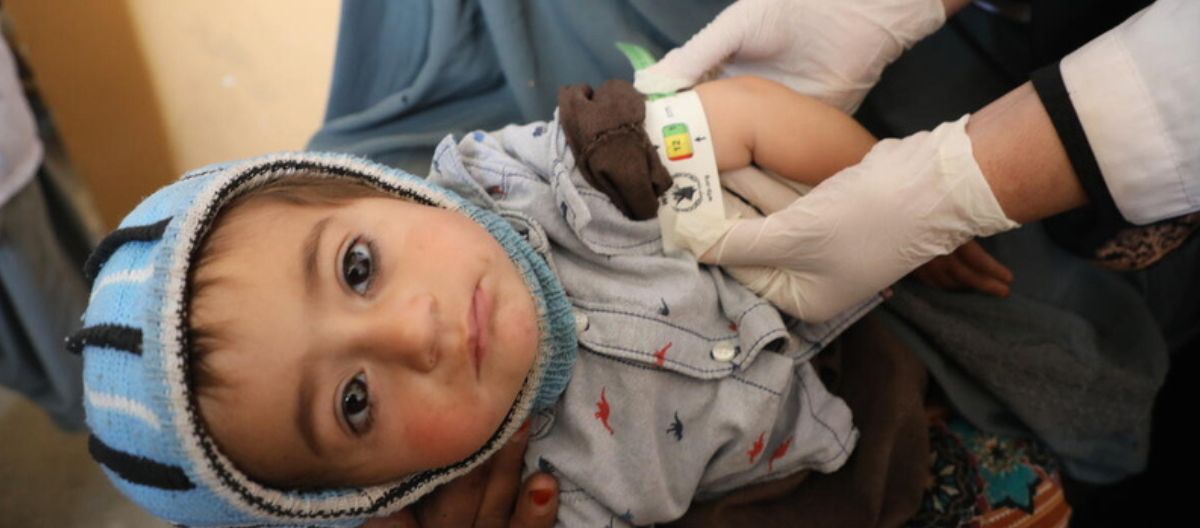 이 사진은 영양실조로 고통 받고 있는 1.5세 아지즈가 WFP가 지원하는 클리닉에서 치료를 받고 있는 모습입니다.