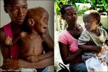 아이티: 영양실조에서 탈출한 소년